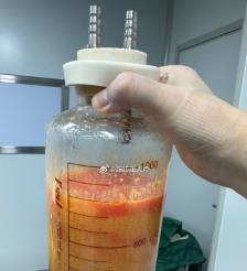 安丘水动力吸脂手术要做多久？